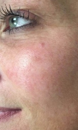 couperose laseren resultaat