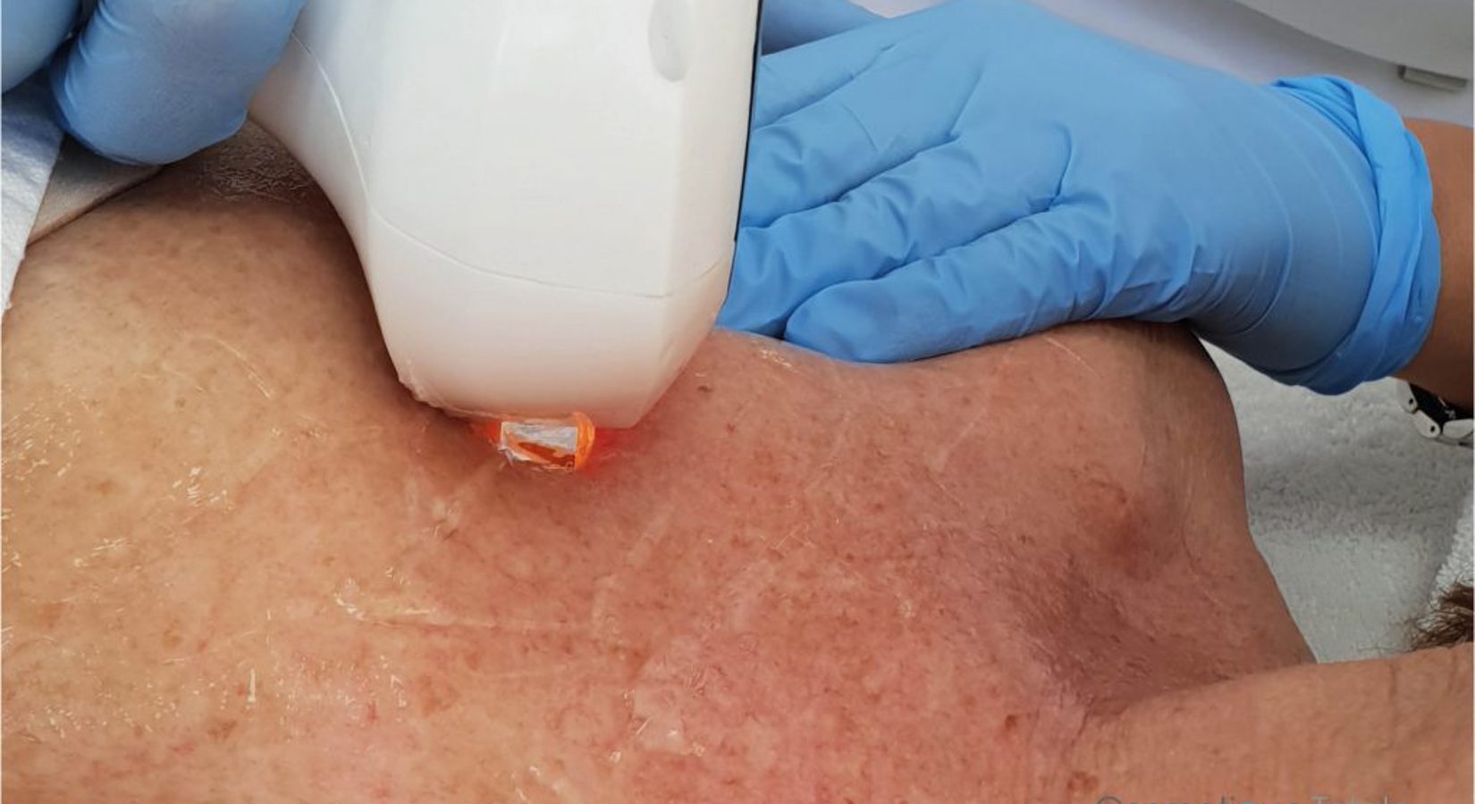 Laserbehandeling Zonneschade