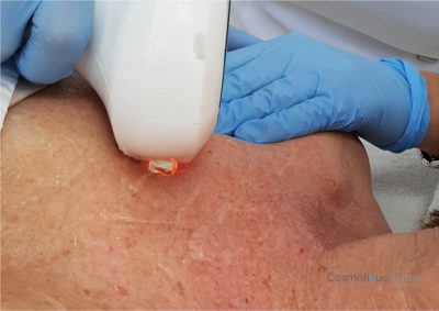 Laserbehandeling Zonneschade